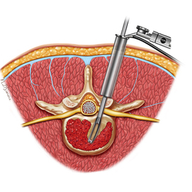 Медицинаская иллюстрация. Операция. Позвоночник.