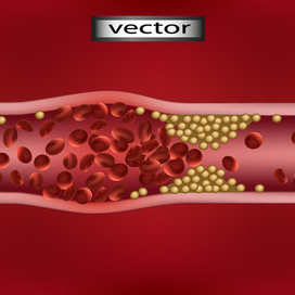 Закупорка сосуда Векторная иллюстрация