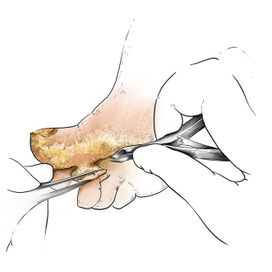 Кератоз. Подология