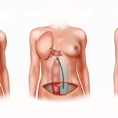 Медицинская иллюстрация. Онкопластика