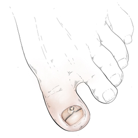 Восстановление ногтя. Подология