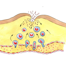 Воспаление / inflammation