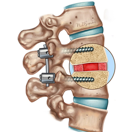 Медицинская иллюстрация. Позвоночник. Операция