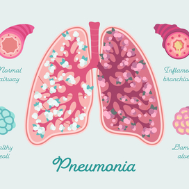 Пневмония. Инфографика для пациентов