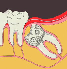 зуб мудрости