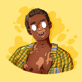 Парень с витилиго