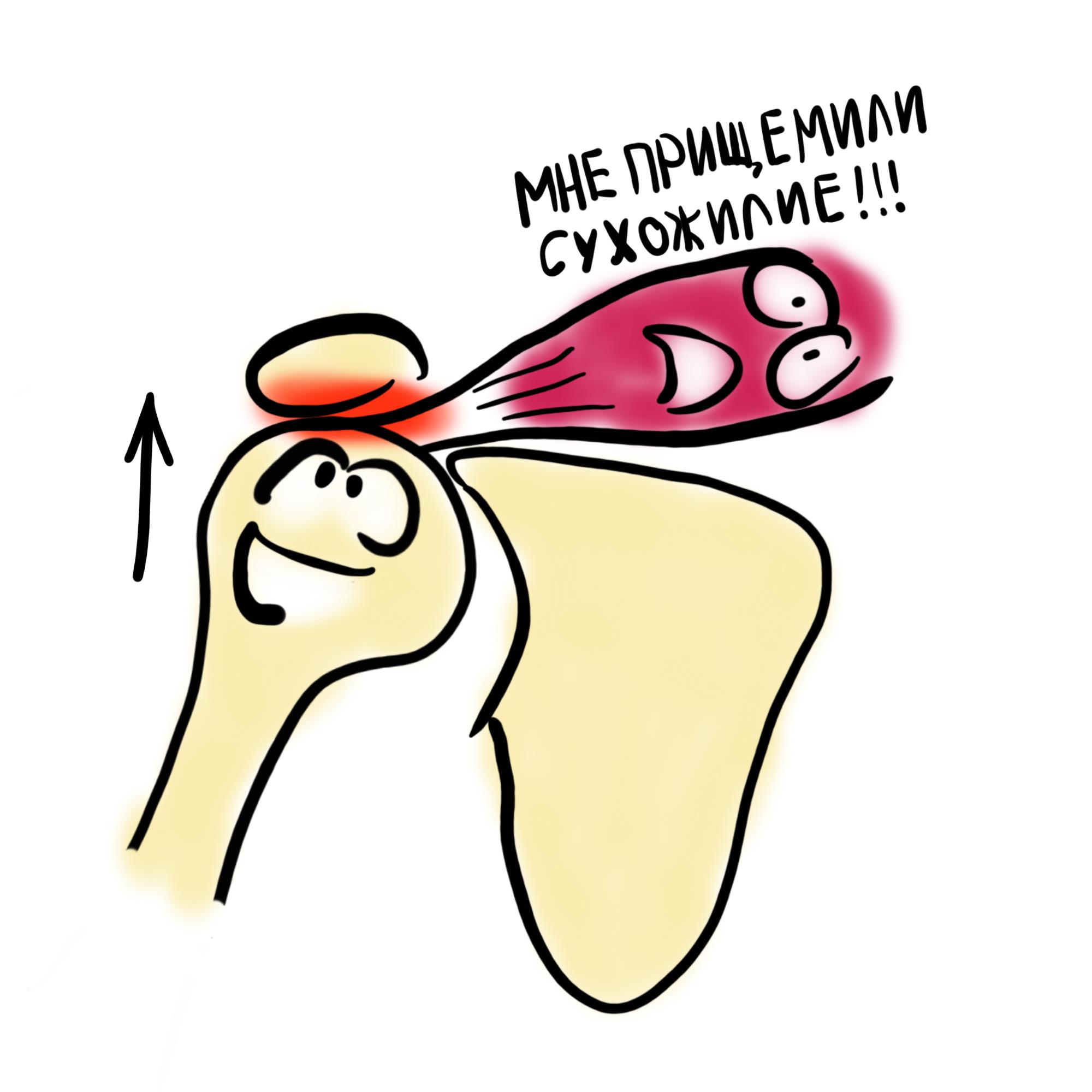 Импинджмент