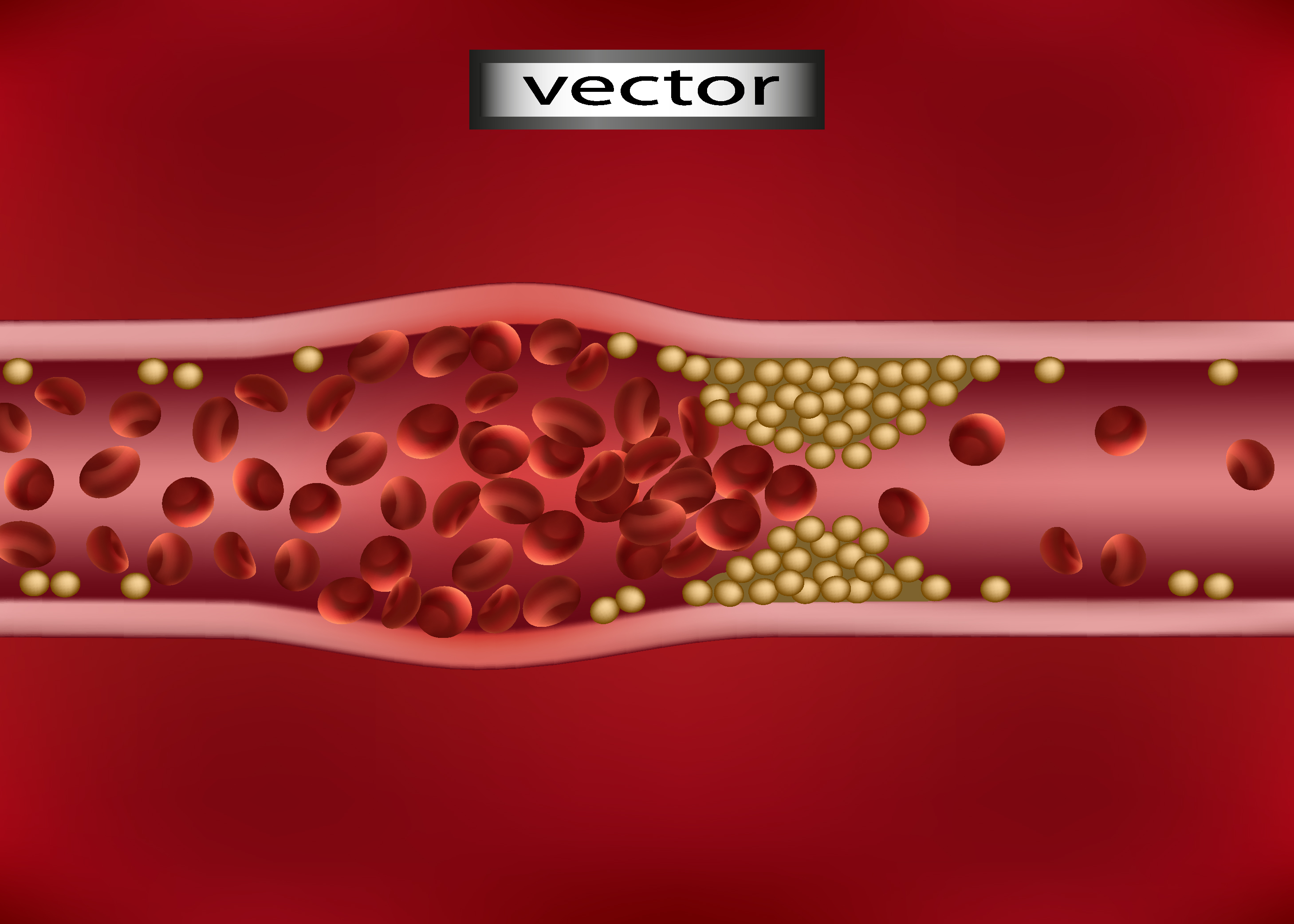 Закупорка сосуда Векторная иллюстрация