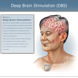 Глубокая стимуляция мозга.Медицинская иллюстрация. Паркинсона.