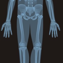 Рентген-тантамареска.