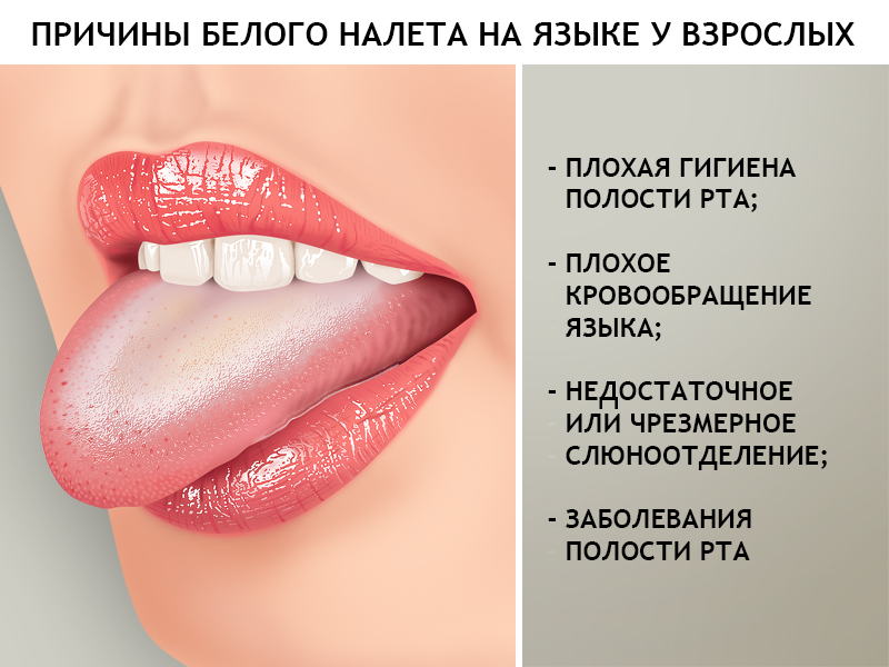 Вкус соды во рту. Что значит белый налет на языке. Заболевания по цвету языка.